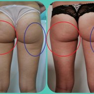 Karboksyterapia